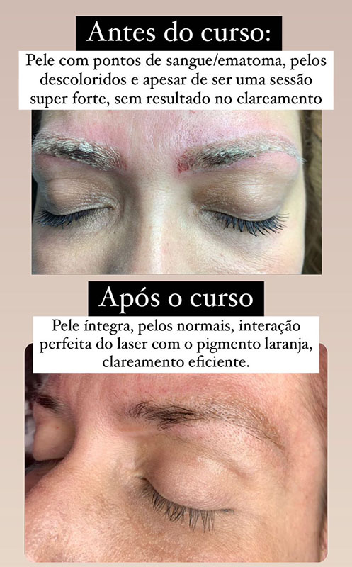 Depoimento Laser Effect (1)