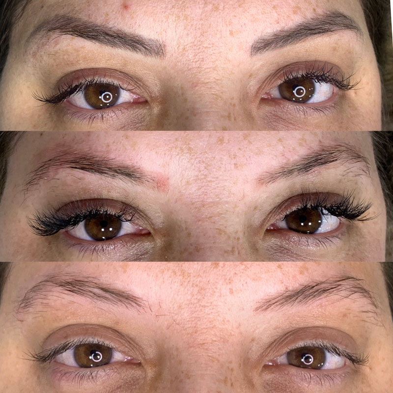 Remoção a Laser (11)