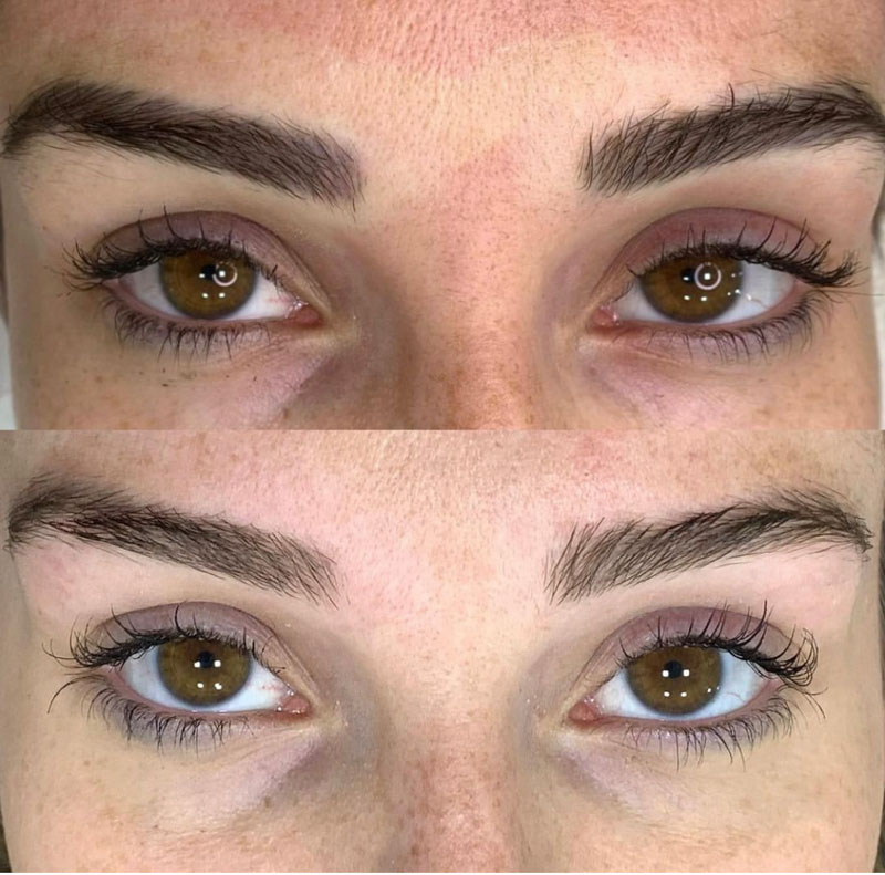 Remoção a Laser (14)