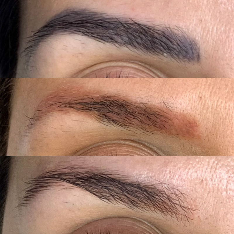 Remoção a Laser (6)