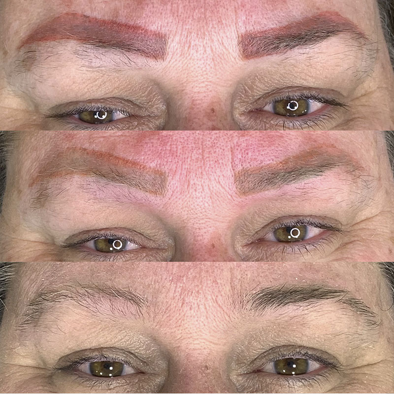 Remoção a Laser 1