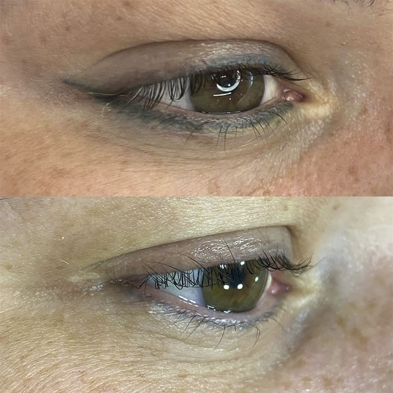 Remoção a Laser 11