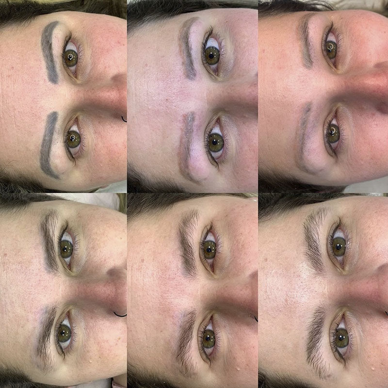 Remoção a Laser 4