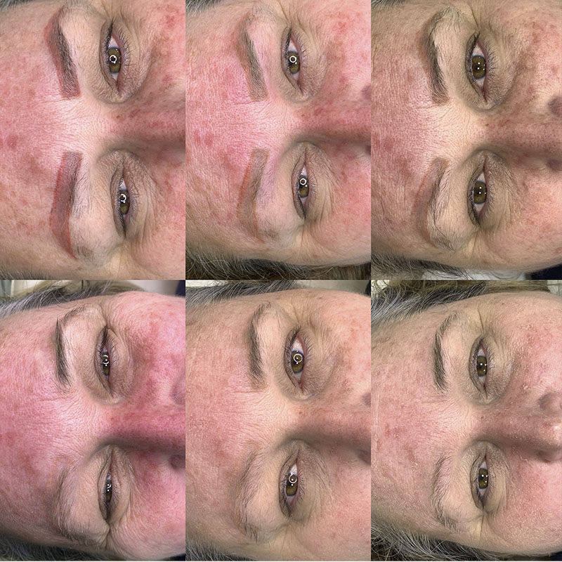 Remoção a Laser 5