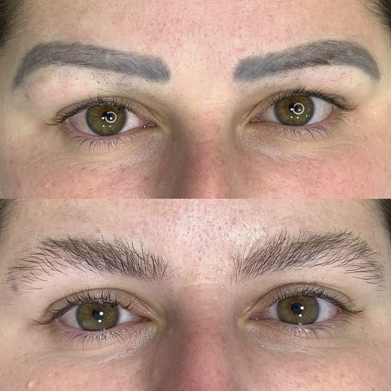 Remoção a Laser 6