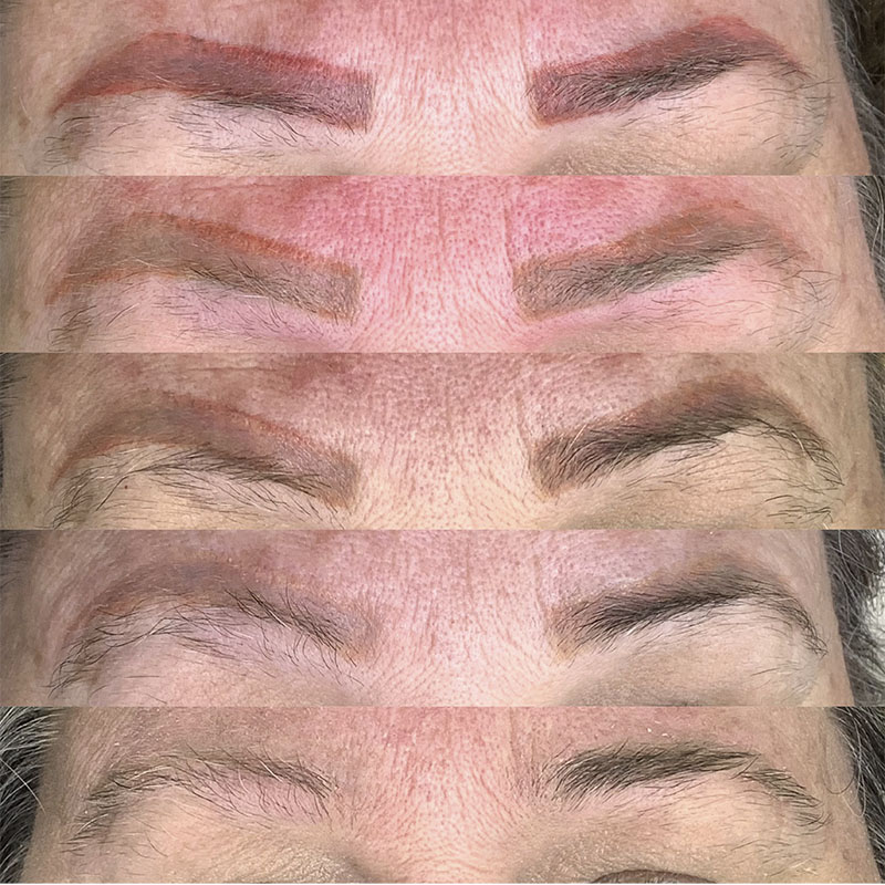 Remoção a Laser 7