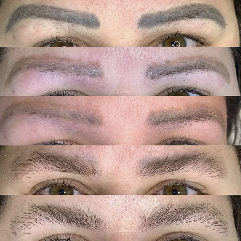 Remoção a Laser