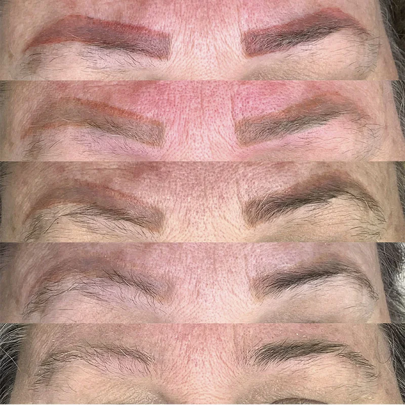 Clareamento de pigmento após remoção a laser
